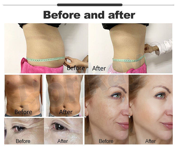 pemf therapy machine cost